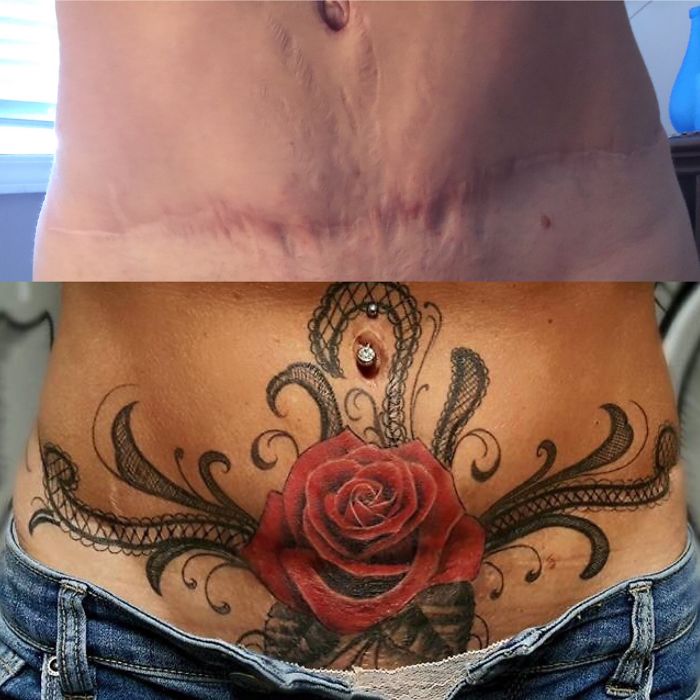 Tummy Tuck Scar Coverup Tattoo.