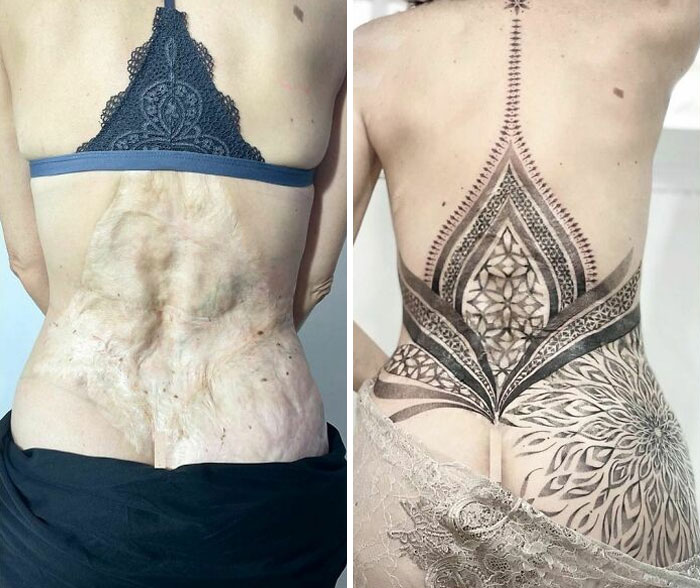 Look How Beautifully Tattoo Artists Cover The Surgery Marks Of