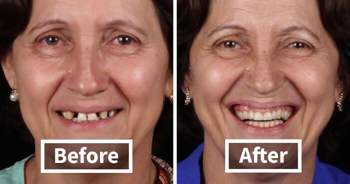 Brazilian Dentist Travels To Treat The Teeth Of Poor People For Free And Here Are 30 Transformations