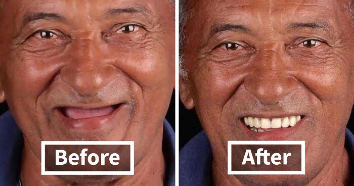 This Brazilian Dentist Fixes Poor People's Teeth For Free And Here Are The Amazing Results (31 New Pics)