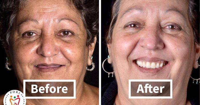 Brazilian Dentist Travels To Treat The Teeth Of Poor People For Free And Here Are 30 Transformations