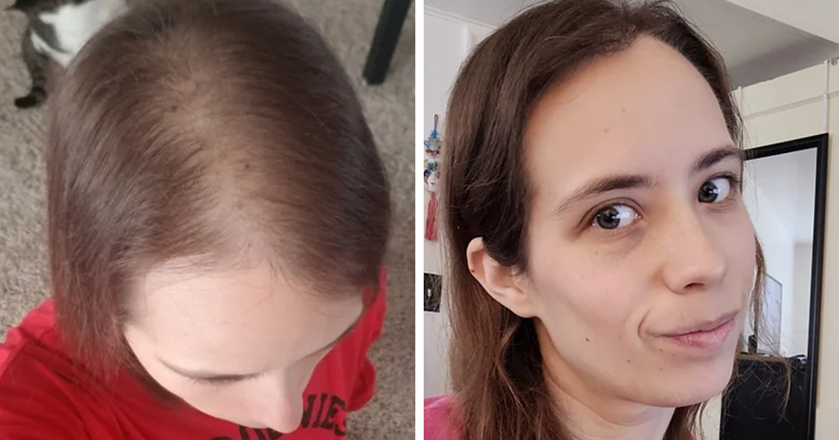 People Who Tried Out Hair Loss Are Sharing Results In Online Community (30 Pics) | Bored Panda