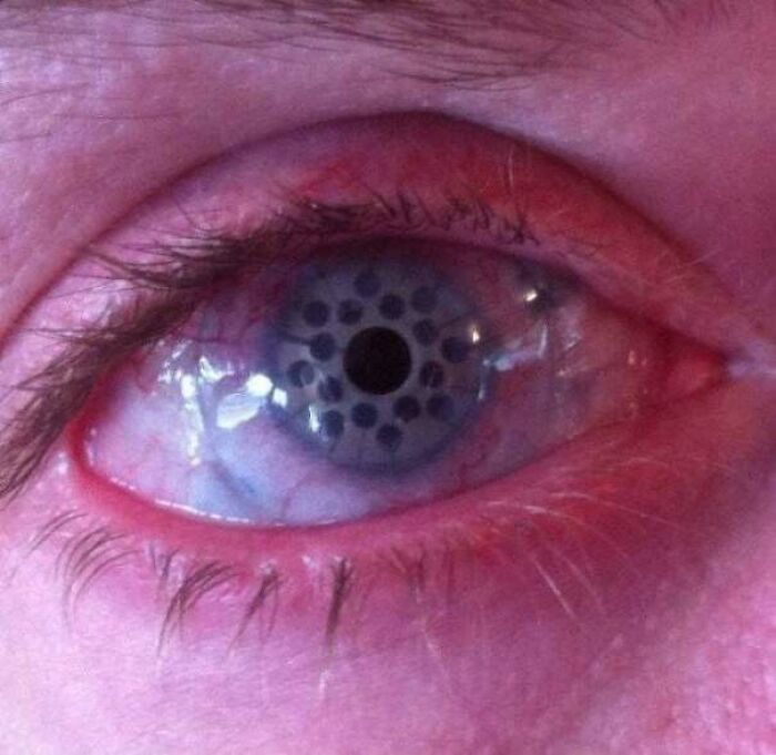 This Is What An Eye Looks Like After Keratoprosthesis: A Surgical Procedure Where A Diseased Cornea Is Replaced With An Artificial Cornea