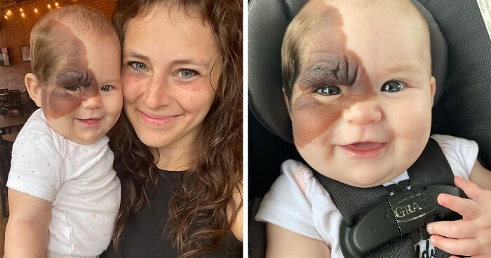 Mom Shares Her Daughter’s Unique Birthmark, Gathering 300k Followers Supporting Their Journey