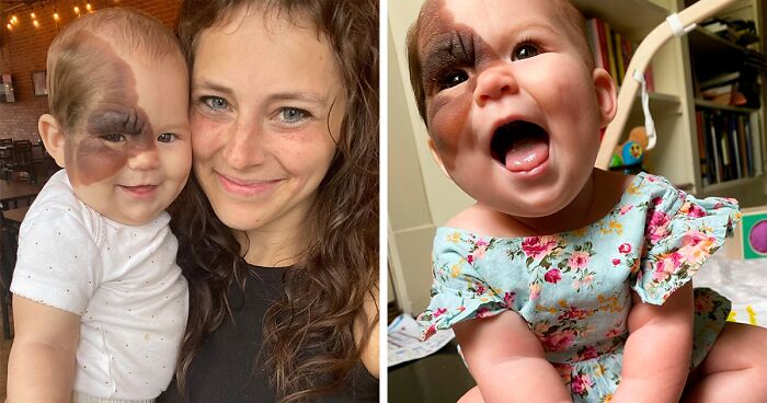 Mom Shares Her Daughter’s Unique Birthmark, Gathering 300k Followers Supporting Their Journey