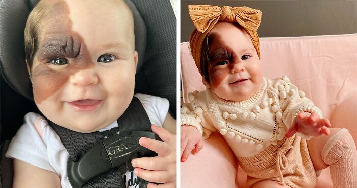 Mom Shares Her Daughter’s Unique Birthmark, Gathering 300k Followers Supporting Their Journey