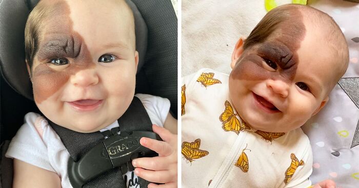 This Little Girl Was Born With A Unique Birthmark And She Is Rocking It