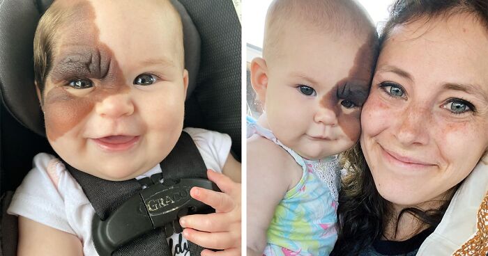 Mom Shares Her Daughter’s Unique Birthmark, Gathering 300k Followers Supporting Their Journey