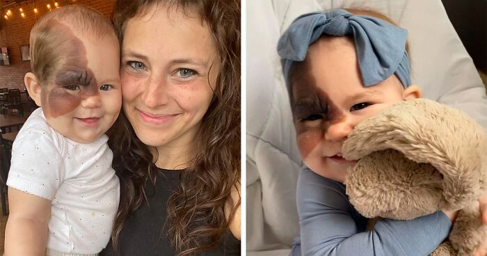 Mom Shares Her Daughter’s Unique Birthmark, Gathering 300k Followers Supporting Their Journey