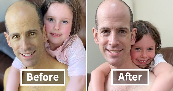 Dad Saved By Liver Transplant Shares Pictures Taken Before And After, Showing His Remarkable Recovery