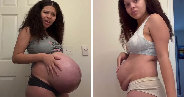 Woman Calls Out Society For Putting Unrealistic Expectations On New Moms To Snap Back To Their Previous Body By Showing The Reality Of It