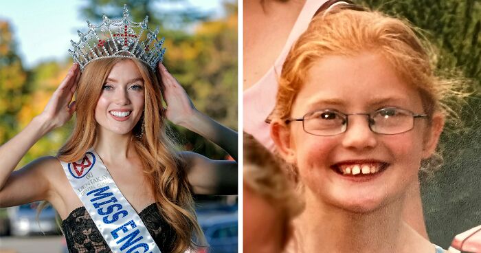 Woman Who Was “Spat At” And “Burned” At School For Having Ginger Hair Grows Up To Be Crowned Miss England