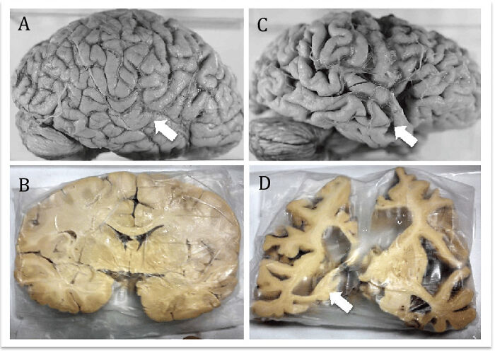 Neuroanatomical Comparison Of Normal Brain And Alzheimer´s Disease Brain