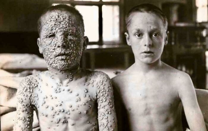 These Two Boys Had Been Exposed To The Same Smallpox Source. One Had Been Vaccinated, The Other Hadn’t
