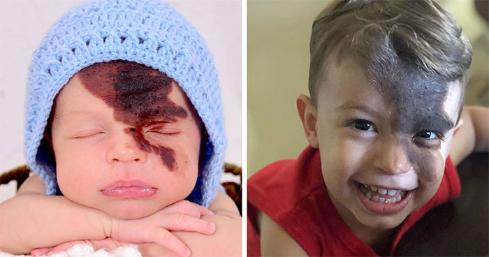 Mother Replicated Her Son’s Birthmark On Her Face To Help Her Child Know How Lovely He Is