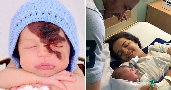 Enzo's Mother Is Embracing Her Son's Unique Birthmark By Replicating It On Her Face