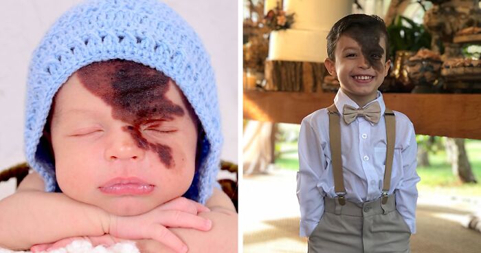 Mother's Initiative To Replicate Her Son's Birthmark On Her Face Helped The Boy Feel More Confident In Who He Is