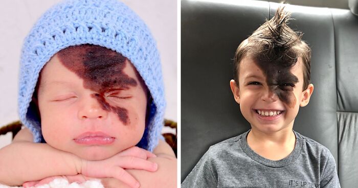 Enzo's Mother Hired A Makeup Professional To Replicate His Birthmark On Her Face To Help Him Feel Proud Of Who He Is