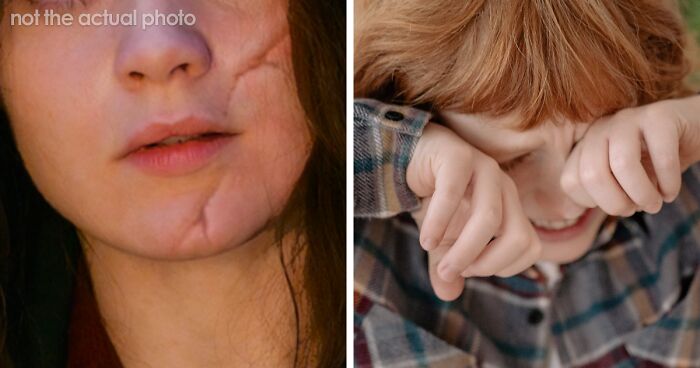 Woman Is Left Crying After Kid Throws A Tantrum Over Her Facial Scar And His Father Asks Her To Cover It