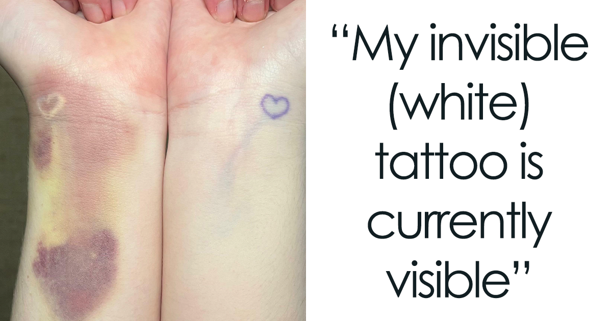 Renewal Laser Clinic  Blowout No reason to have that tattoo bruise on you  arm for a day longer Blowouts What are they When the tattoo pigment has  gotten suspended in the