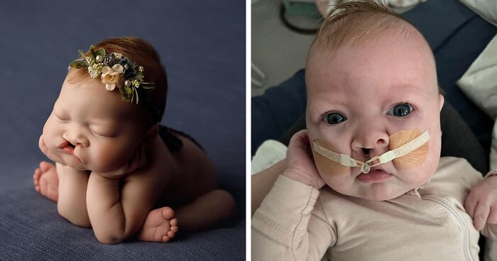 Meet Sutton, A Baby From Texas Born With A Cleft Lip Whose Story Went Viral And Inspired People Around The World