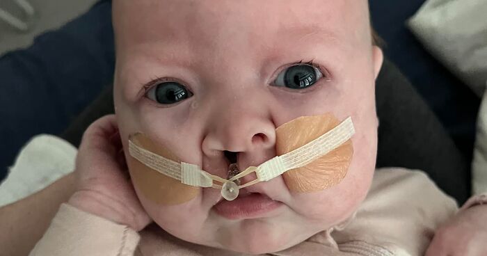 Meet Sutton, A Baby Born With A Cleft Lip Whose Story Went Viral After Her Photograph Was Posted On Social Media