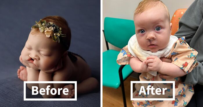 Baby Sutton From Texas Was Born With With A Cleft Lip And Her Story Went Viral, Inspiring Thousands Of People Around The World