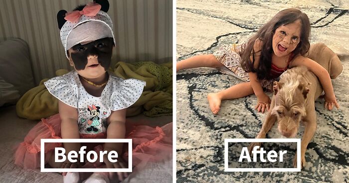 This 4-Year-Old Girl Has Undergone Multiple Surgeries To Get Her Characteristic Birthmark Removed From Her Face