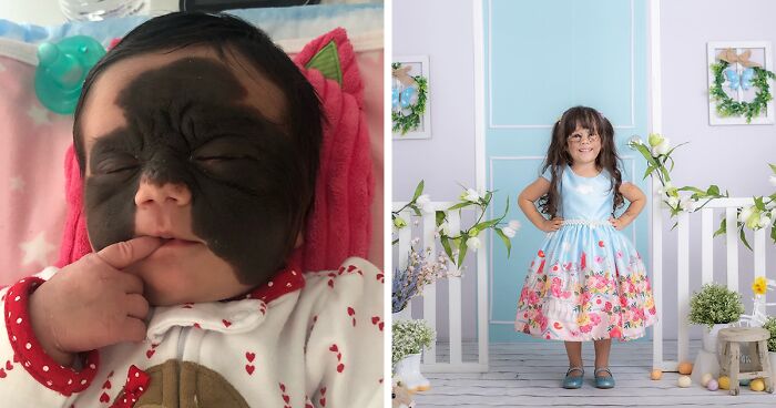 Luna, A 4-Year-Old Girl, Was Born With A Dangerous Birthmark, Which By Now Is Fully Removed