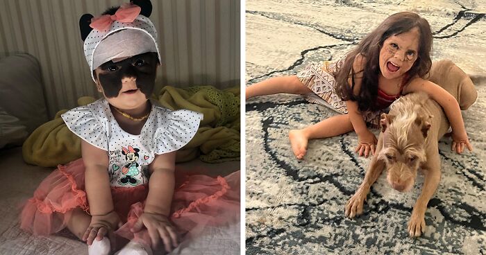 This Girl Came Into The World With A Life-Threatening Birthmark On Her Face Which Is Now Fully Removed