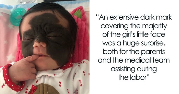 This 4-Year-Old Girl Went Through Many Surgeries To Get A Dangerous Birthmark Removed From Her Face