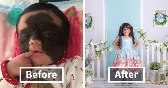 Luna Was Born With A Dangerous Birthmark Which, Thanks To Many Surgeries, Was Removed From Her Face