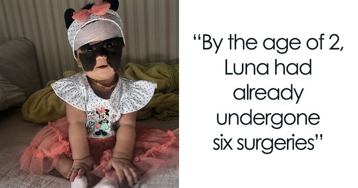 The Story Of Luna: A Girl Born With A Dangerous Facial Feature Underwent Many Surgeries To Get It Removed