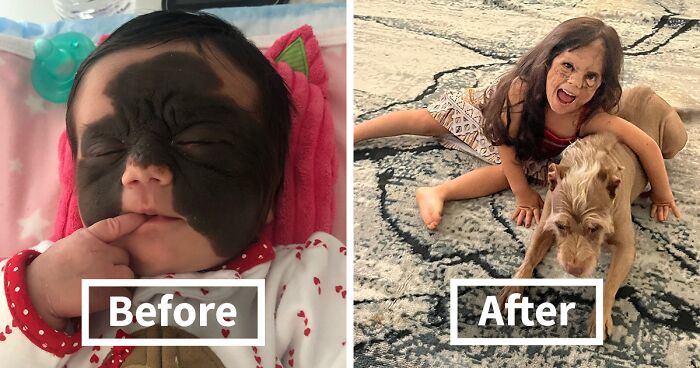 This Girl Came Into The World With A Birthmark On Her Face That Threatened Her Life