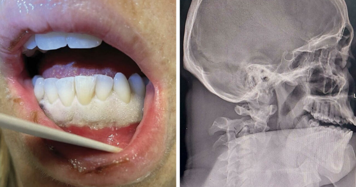 40 Bizarre And Inspiring Medical Cases That People Shared On This Online Community (New Pics)