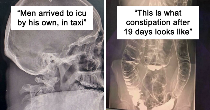 46 Medical Cases That Are Interesting And Bizarre At The Same Time (New Pics)