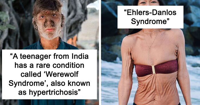 65 People Whose Unique Genetics Show Just How Interesting Humans Can Be