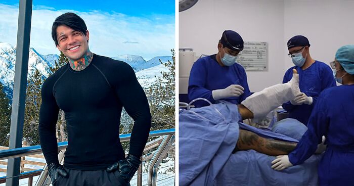 Colombian Man Wanting To Become 6 Feet Tall Spends $175K On Lower Limb Lengthening Surgery 