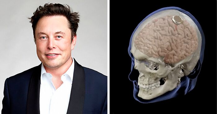 A Year After Receiving FDA Approval, Elon Musk’s Neuralink Attaches Chip In Human Brain