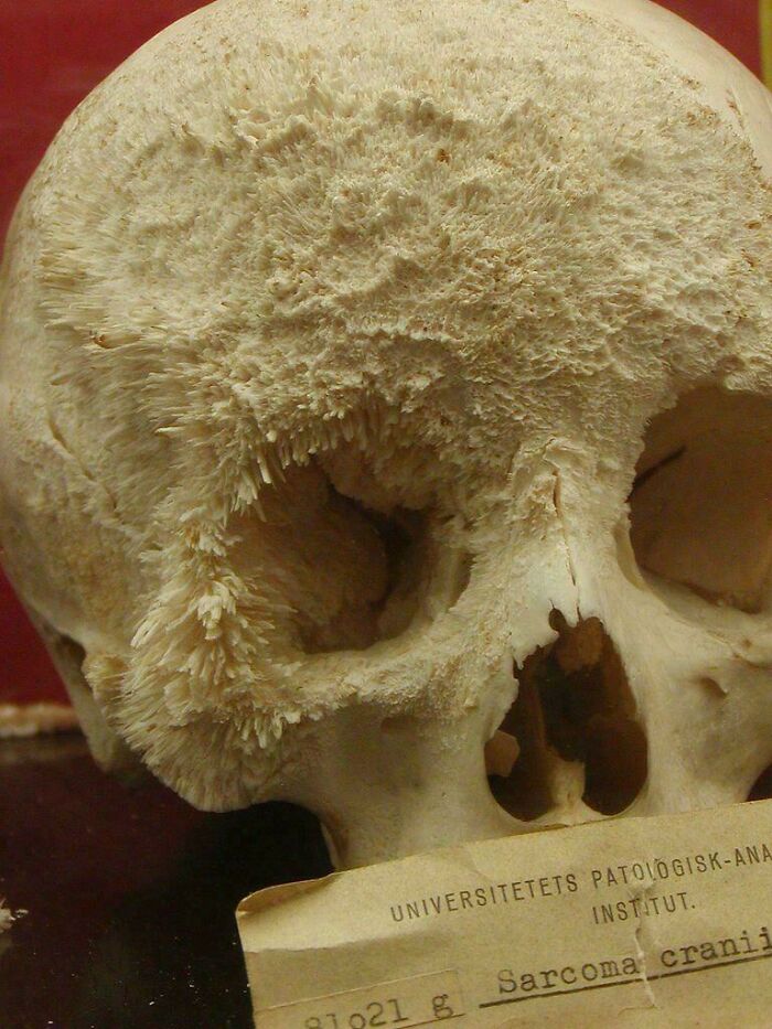 Close-up of a skull with bone growths labeled "Sarcoma craniosin" in a medical display.