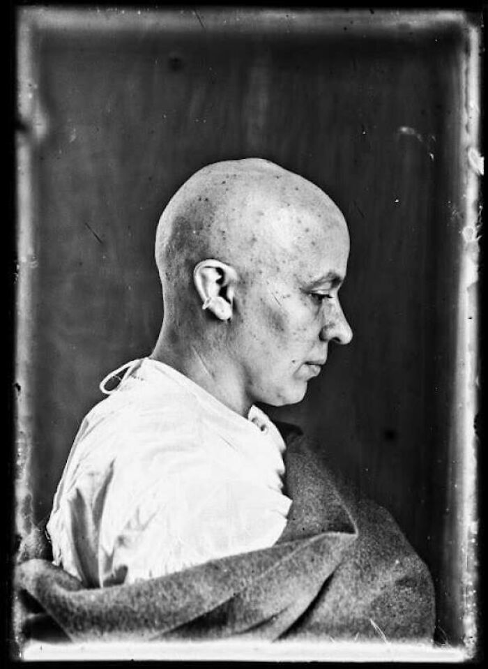 Haunting Portraits Of Surgery Patients Of Dr. Harvey Cushing From The Early 20th Century