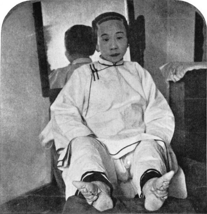 A Chinese Lady Whose Feet Were Bound From Childhood. Late 1800s