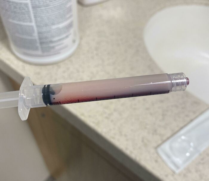 Syringe filled with separated blood plasma and red cells, showcasing an interesting medical case study.