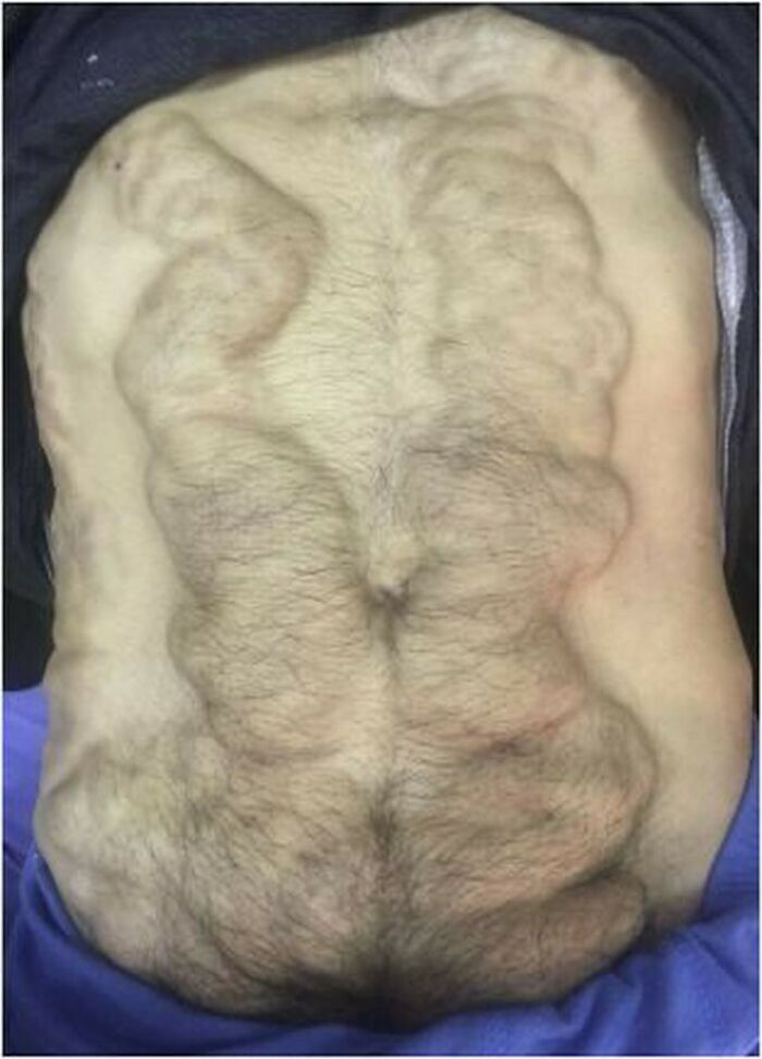 Unique medical case showing a hairy back with distinct skin patterns, illustrating the human body's complexity.