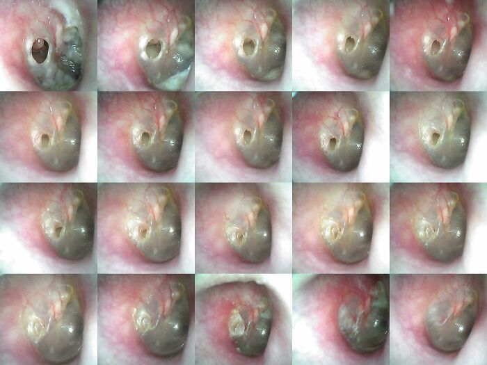 Close-up series of a medical case showing detailed ear examination, highlighting the human body's complexities.