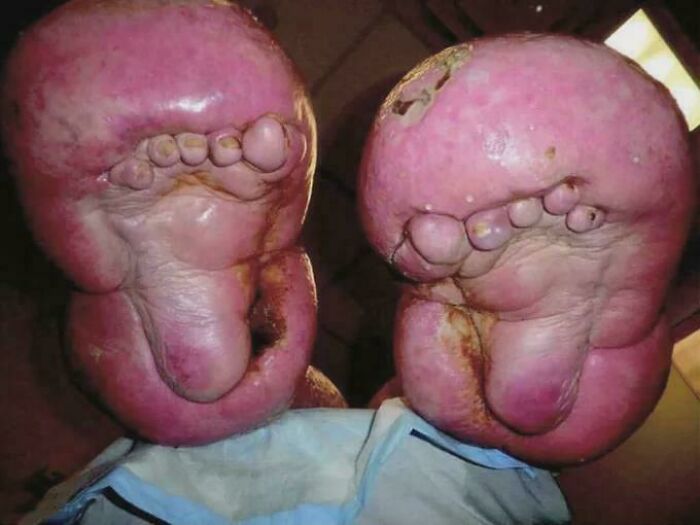 Unusual medical case showcasing an extreme foot condition, highlighting the complexity of the human body.