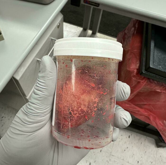 Gloved hand holding a medical specimen jar, demonstrating an interesting medical case.