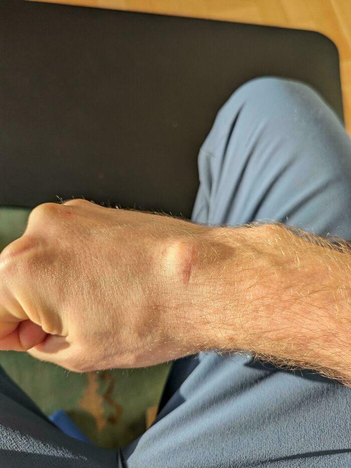 My Ganglion Cyst Reappeared Where I Had It Surgically Removed Last Year