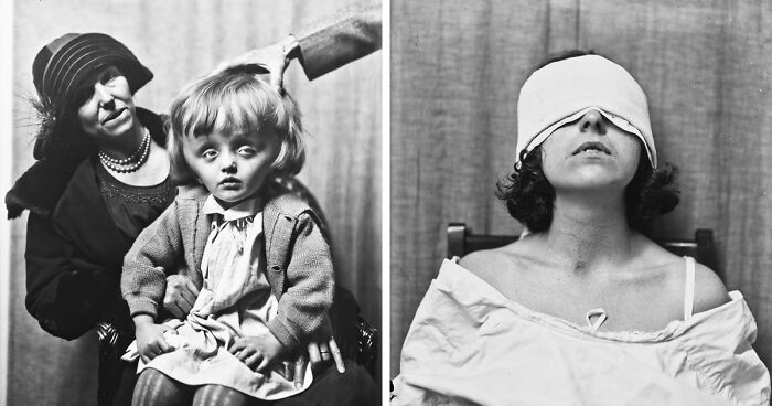 20 Eerie Pictures Of The Patients Of The Pioneer Of Brain Surgery, Dr. Harvey Cushing