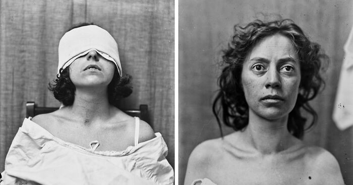 20 Eerie Portraits Of Brain Surgery Patients From The 20th Century